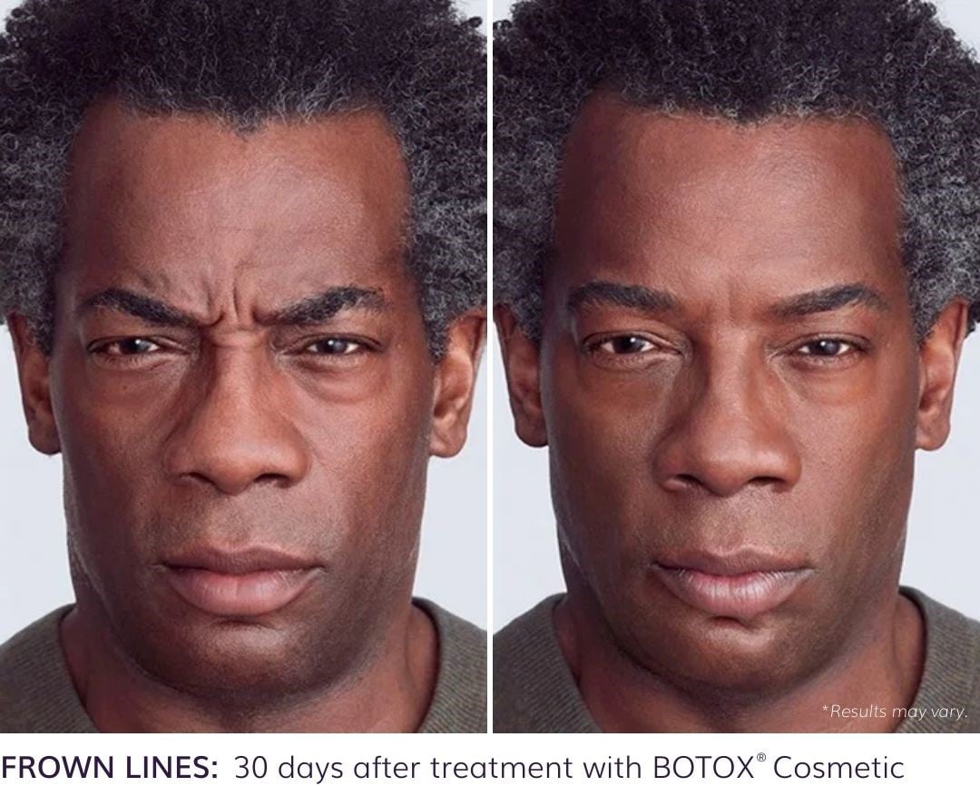 botox before and after image