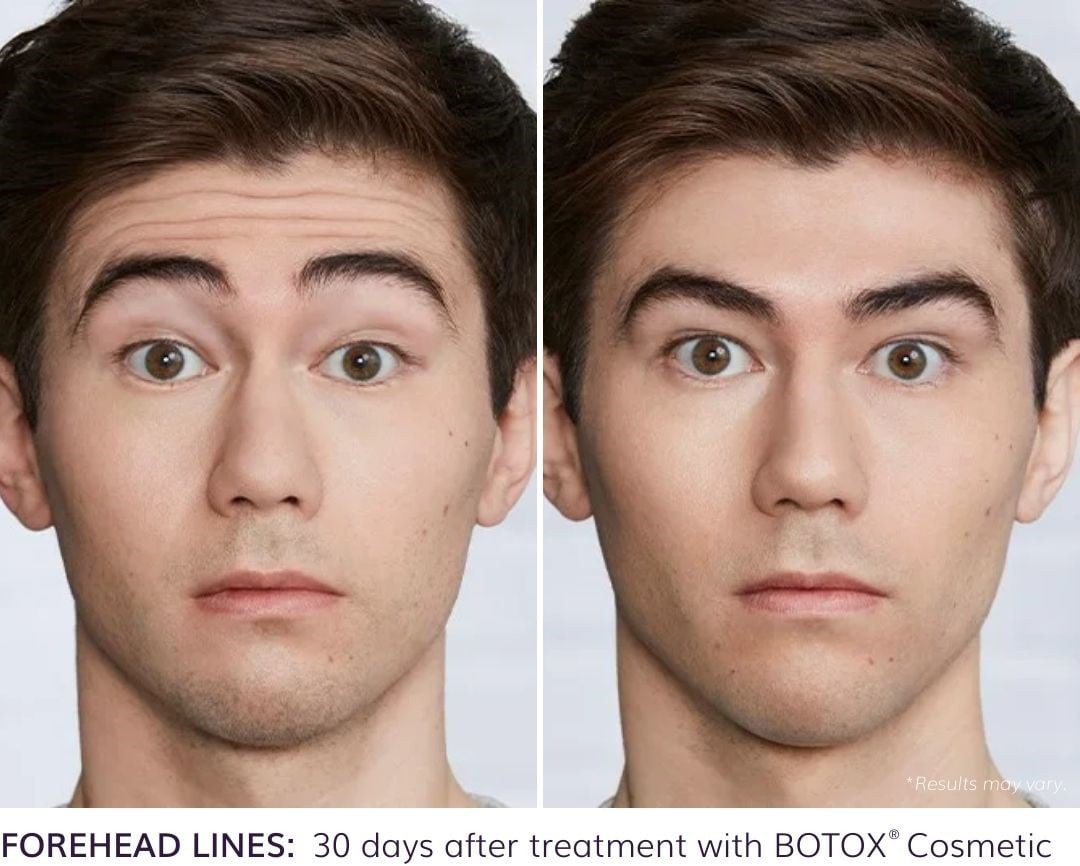 botox before and after image