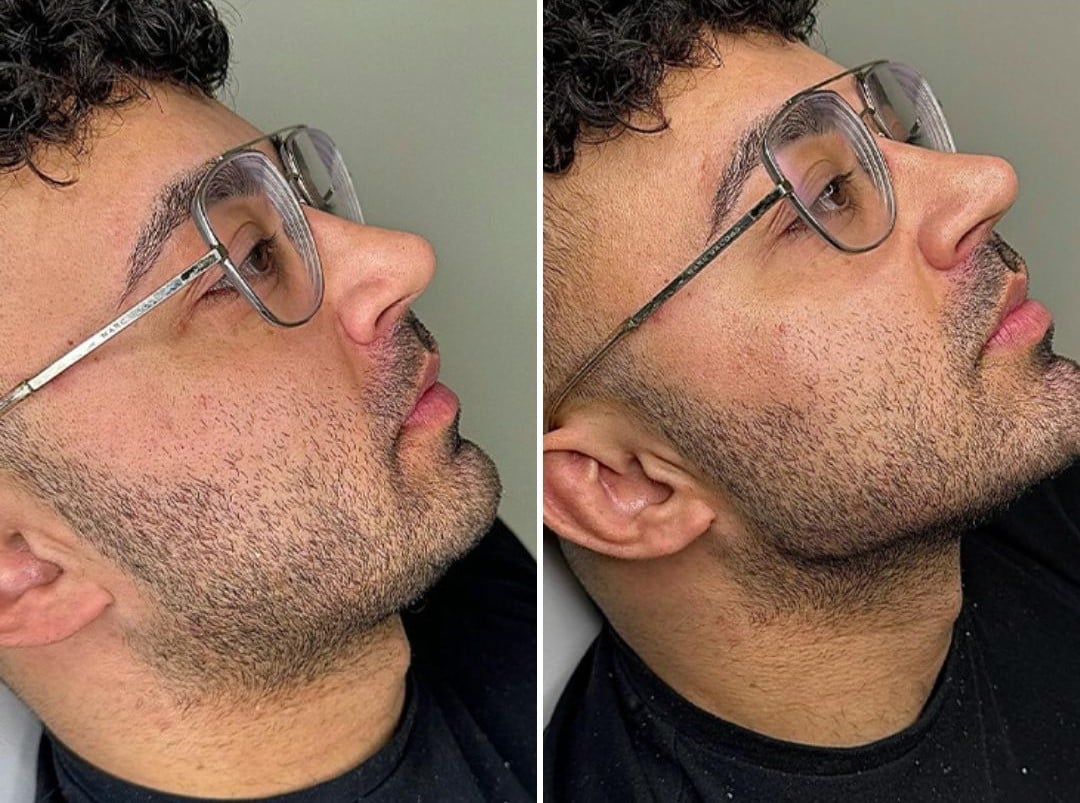 jawline before and after