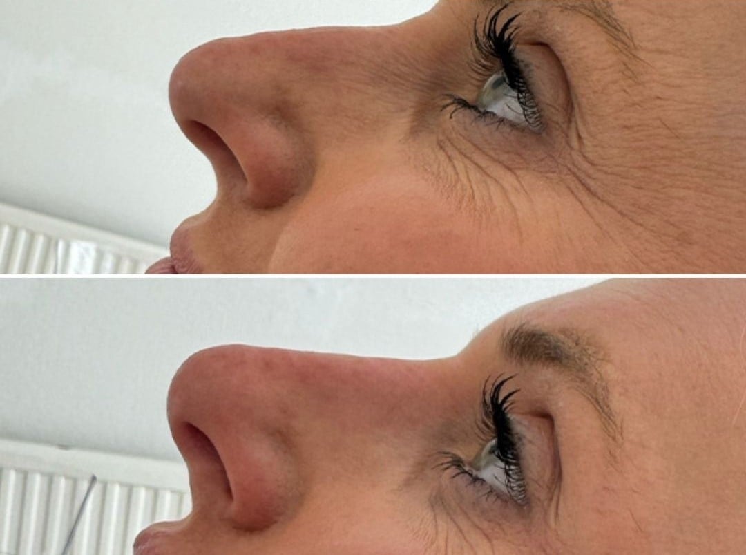 nose before and after
