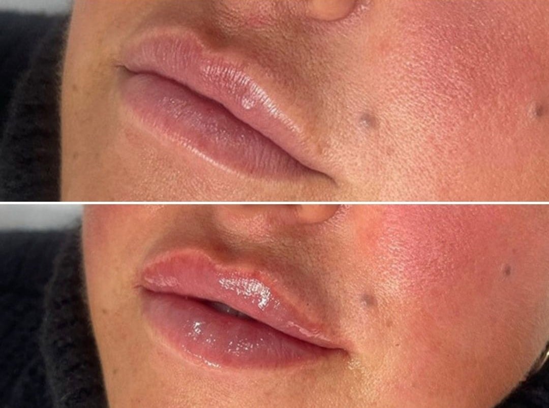 lips before and after