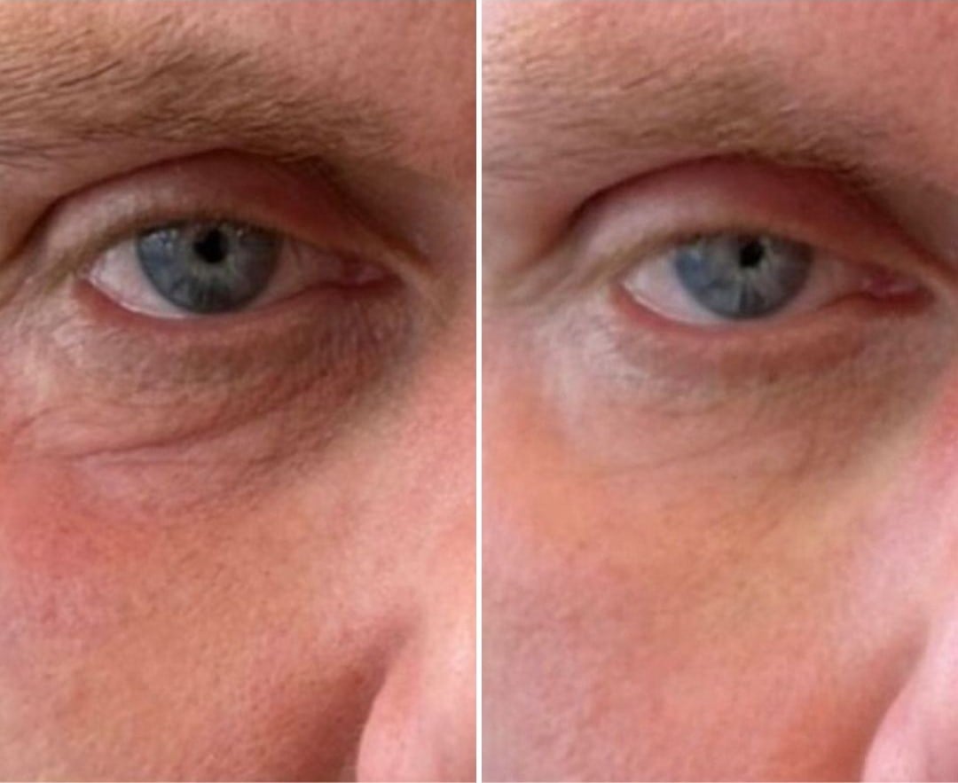 NUCLEOFILL Before & After Eyes