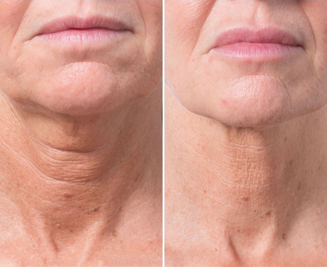 NUCLEOFILL Before & After Décolletage