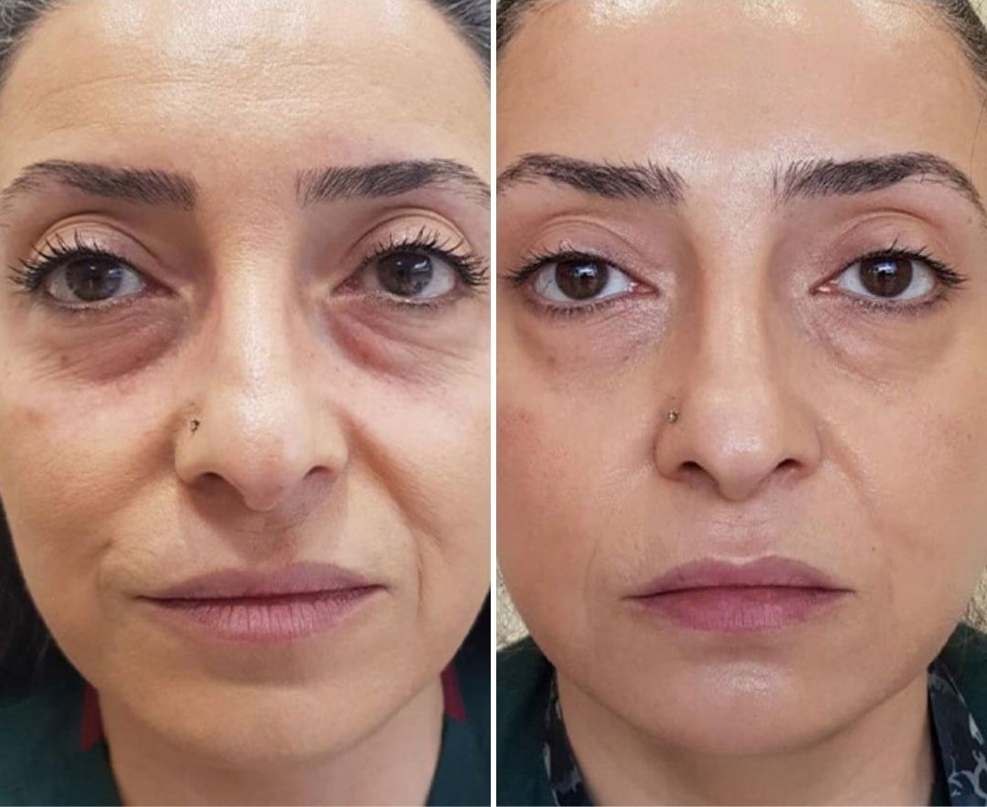 NUCLEOFILL Before & After Face