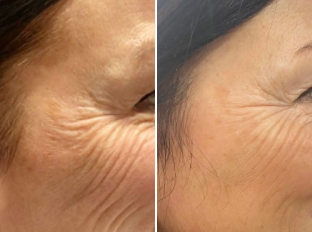PROFHILO Before & After 2