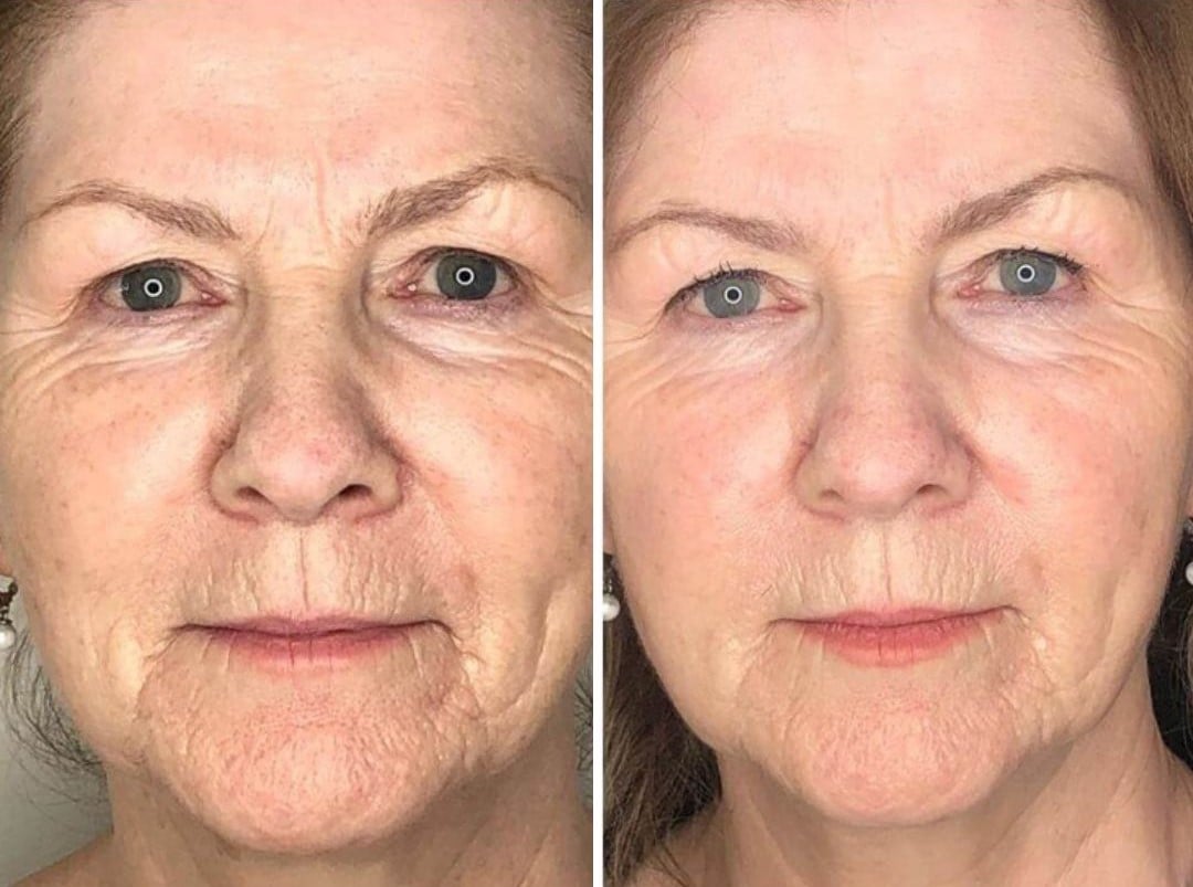 PROFHILO Before & After 1