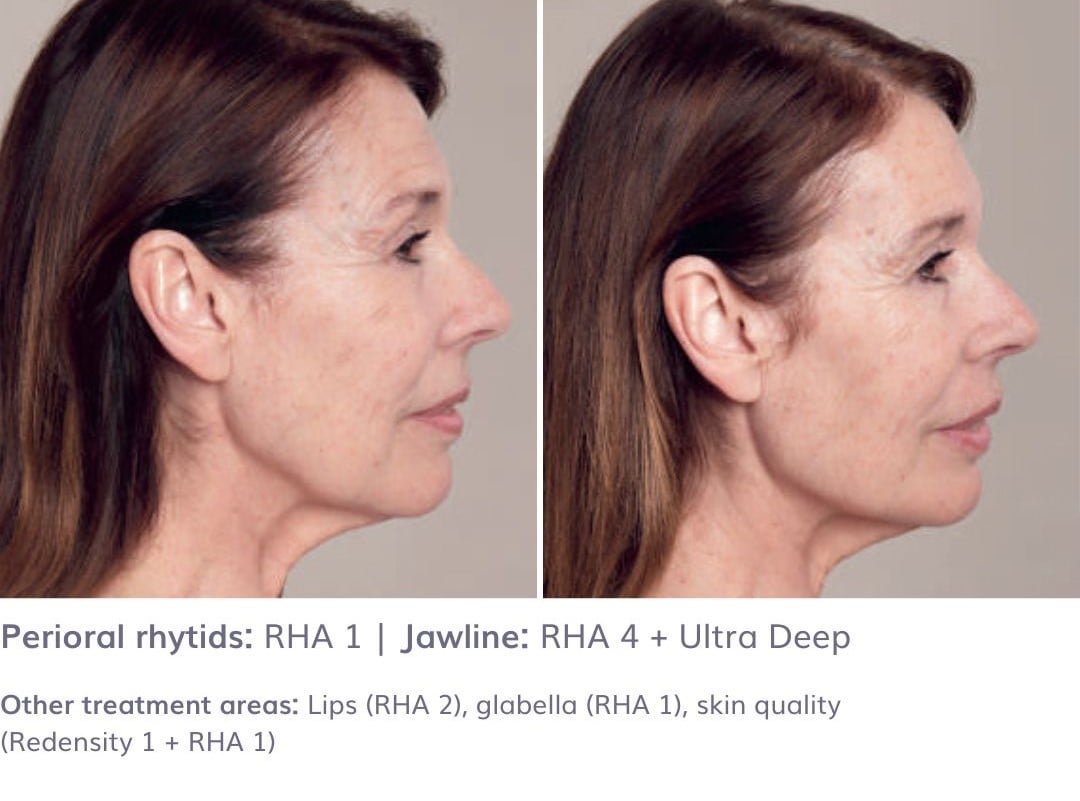 Perioral Rhytids: RHA 1 | Jawline: RHA 4 + ULTRA DEEP