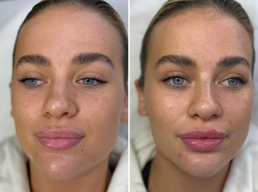 UTH SUB-Q Before & After 3