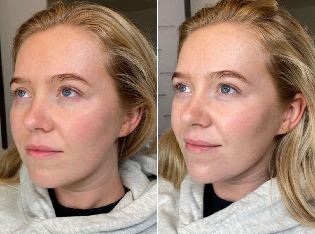 UTH SUB-Q Before & After 1