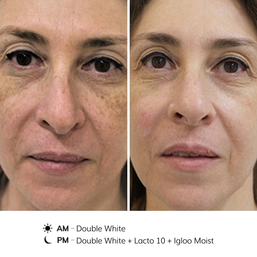 NOON Before & After - Pigmentation
