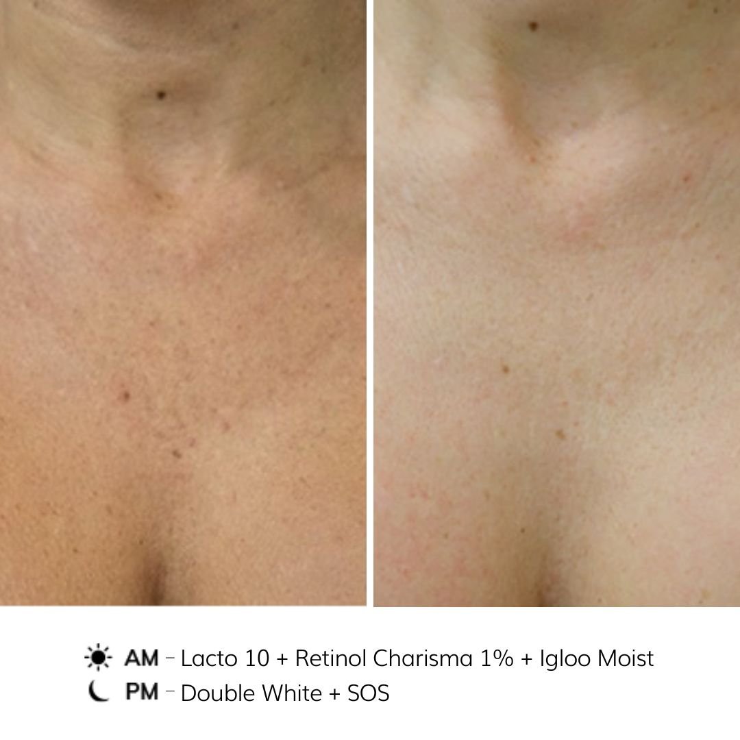 NOON Before & After - Pigmentation