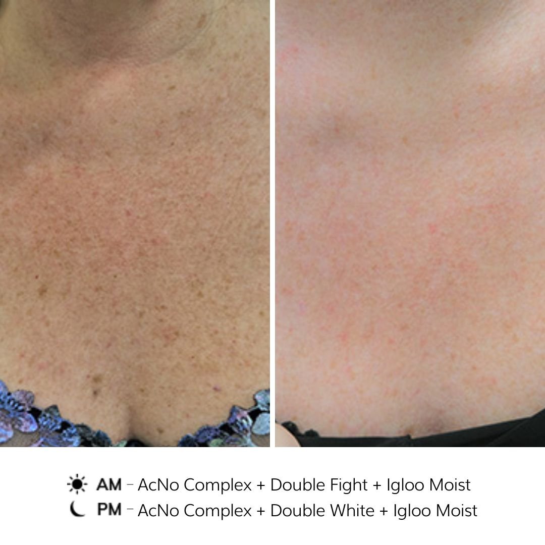 NOON Before & After - Sun Damage