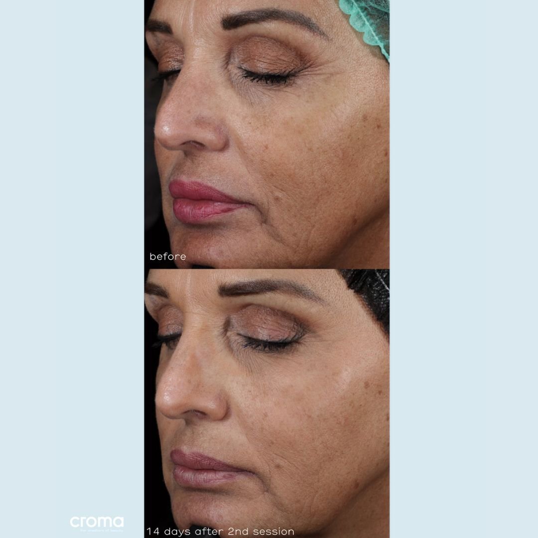 Croma Revitalis 1 x 1ml - Before & After