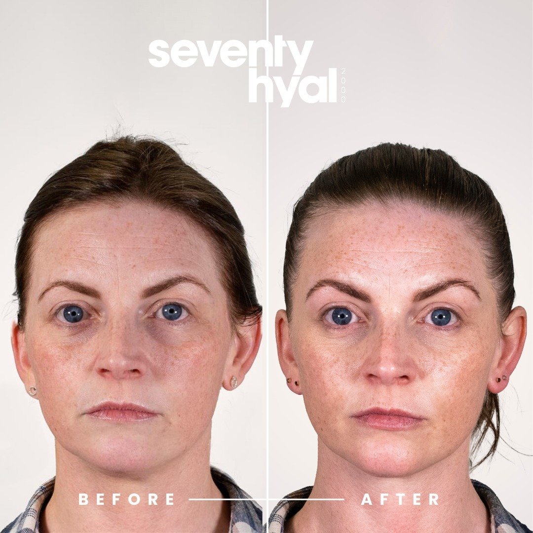 Seventy Hyal Before & After 1