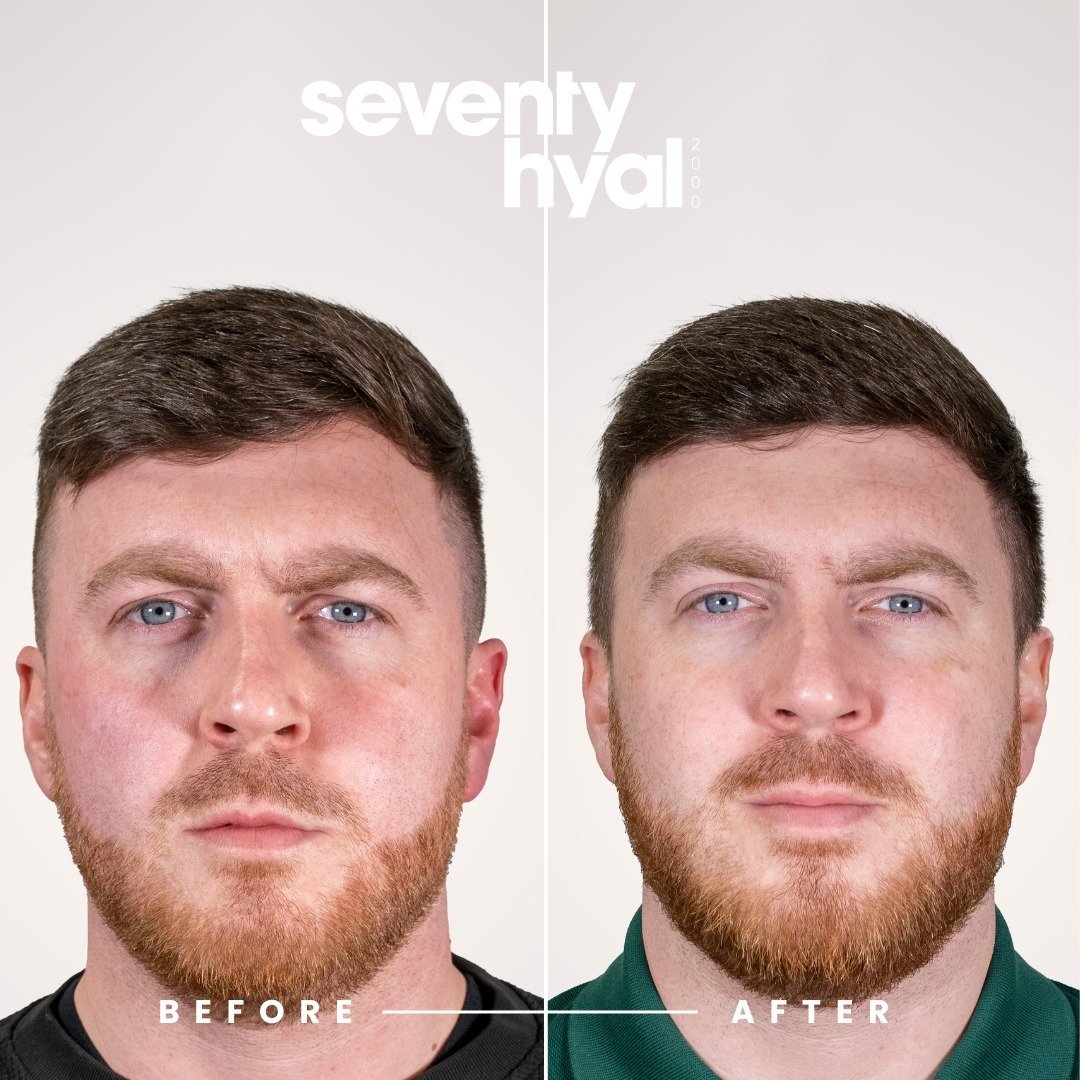 Seventy Hyal Before & After 2