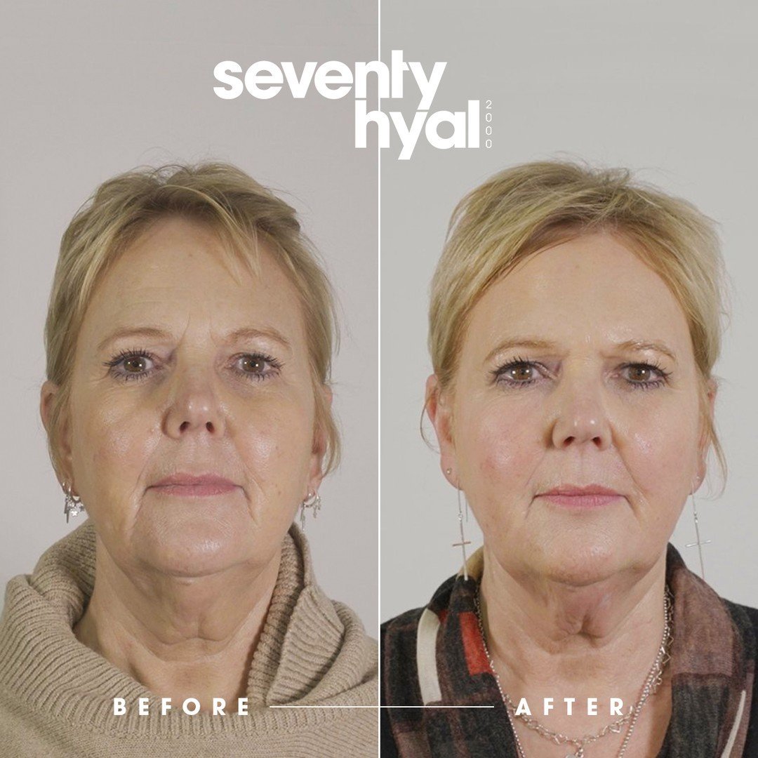 Seventy Hyal Before & After 3