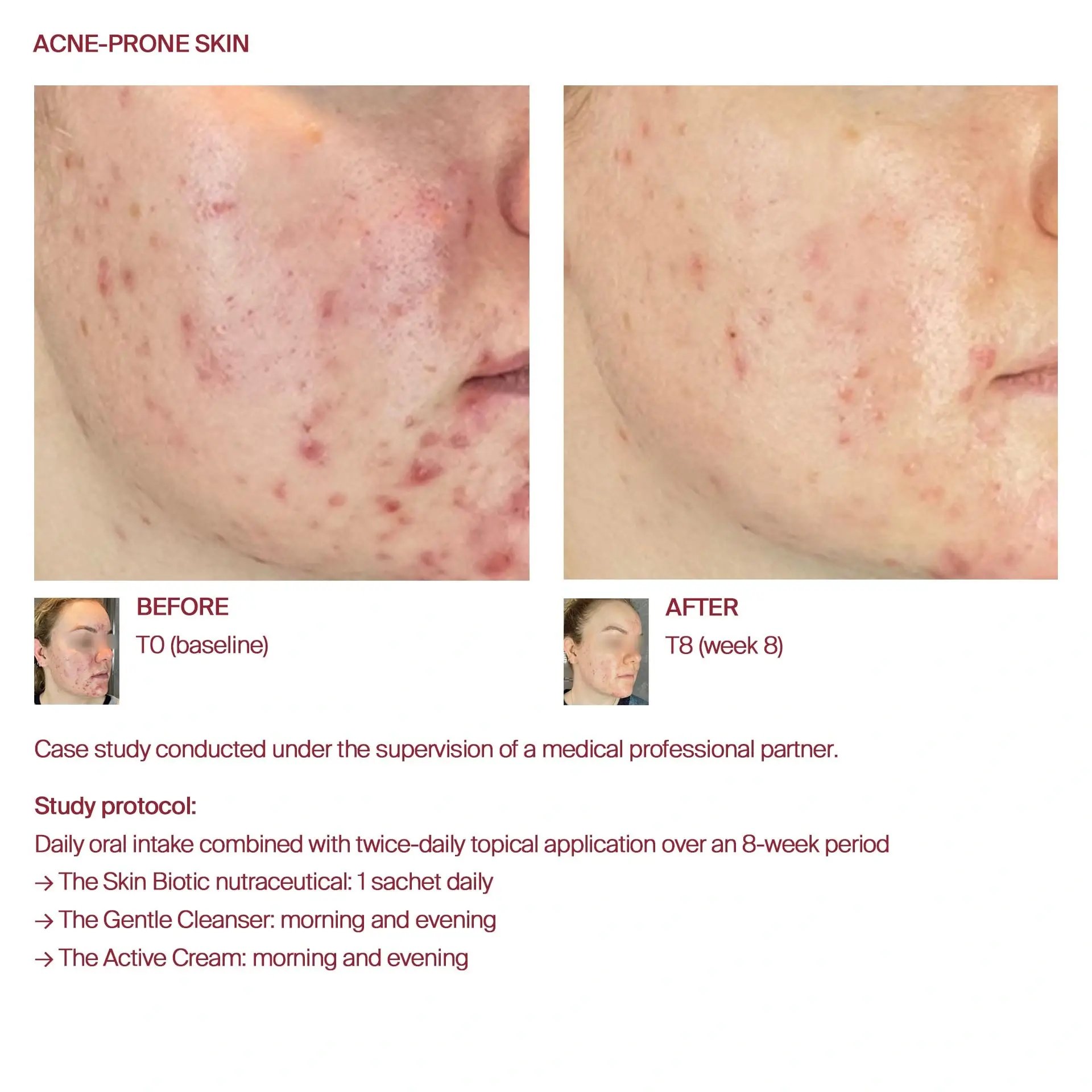 AWvi before and after acne-prone