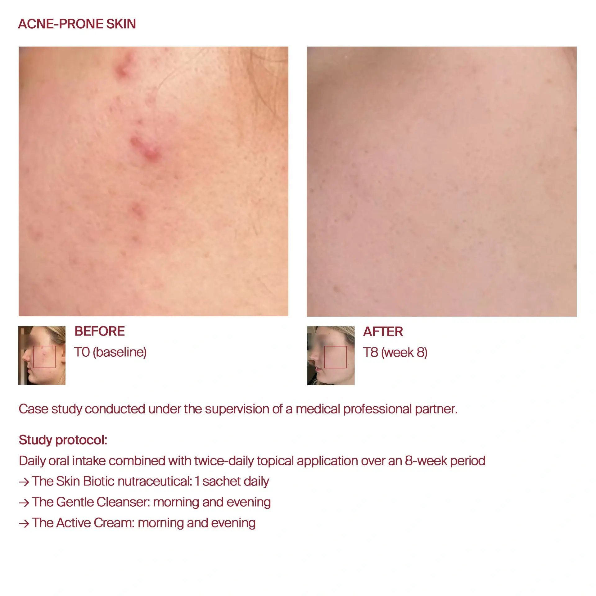 AWvi before and after acne-prone