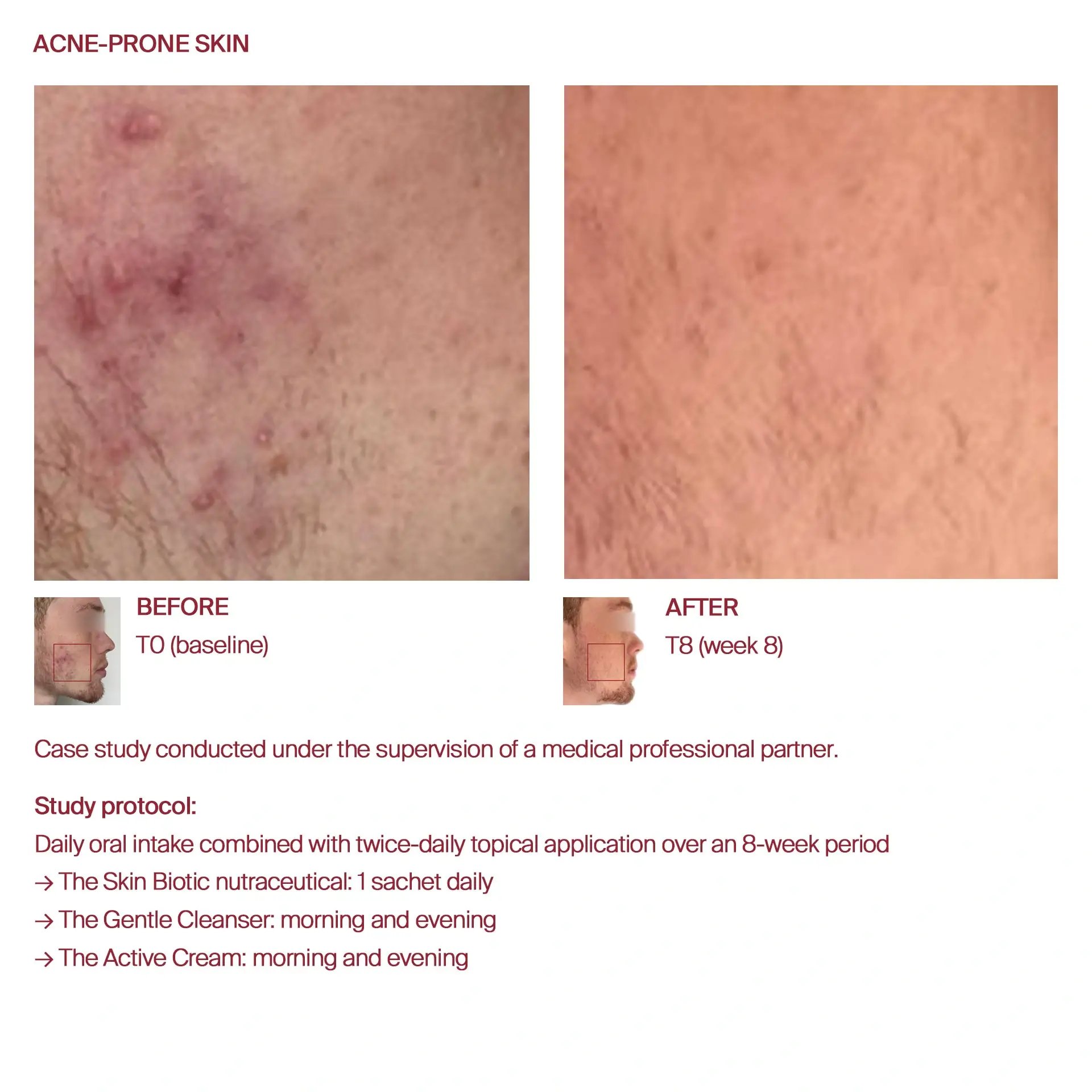 AWvi before and after acne-prone