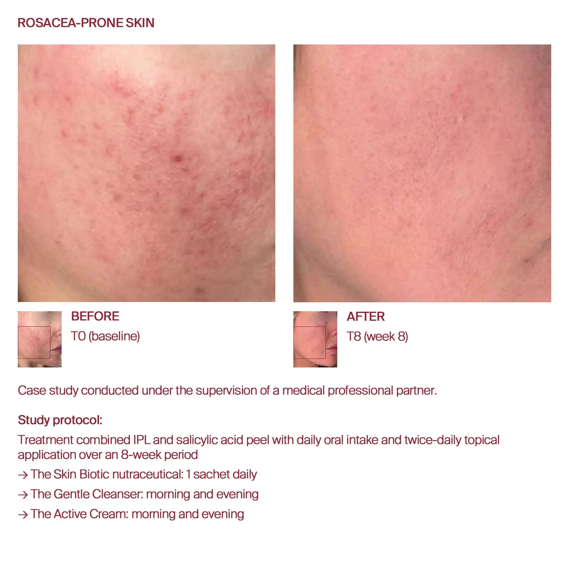 AWvi before and after rosacea