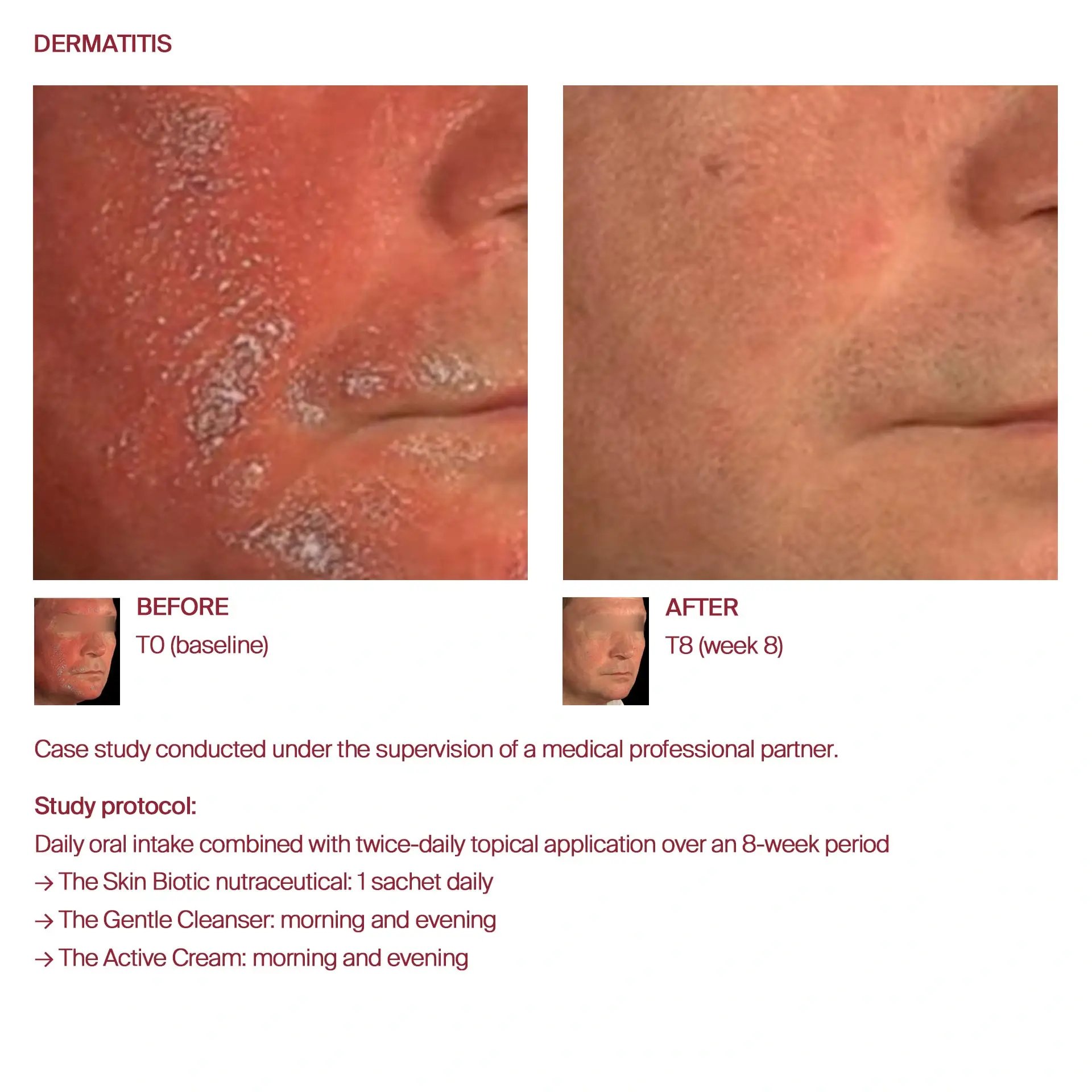 AWvi before and after dermatitis