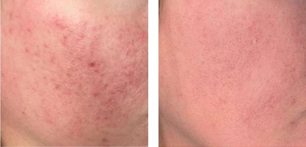 Rosacea before and after