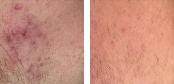 Acne before and after