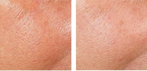 Acne before and after