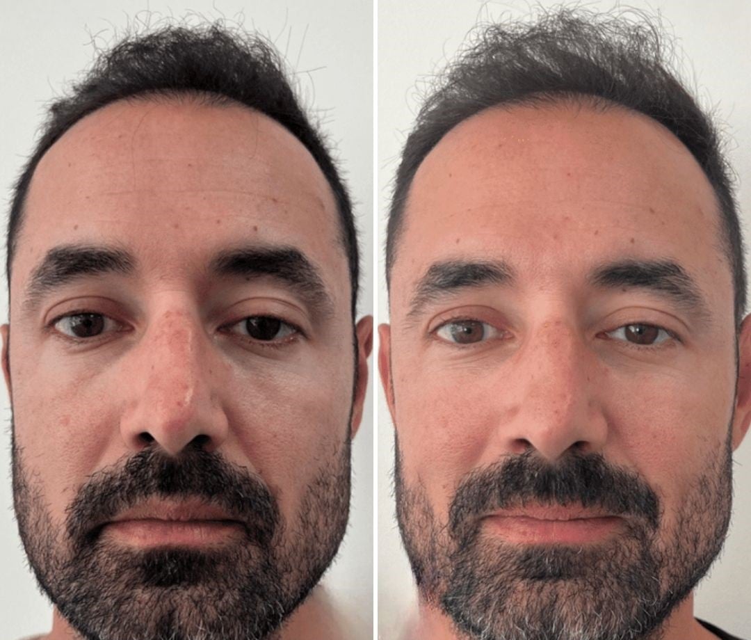 plinest eye before and after