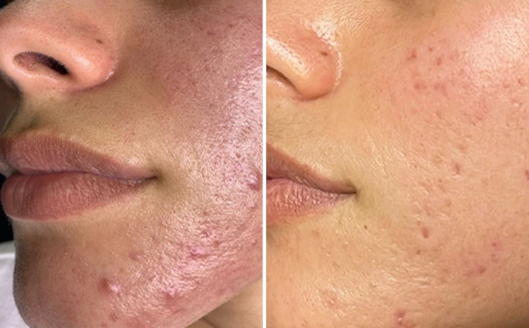 noon skincare before and after