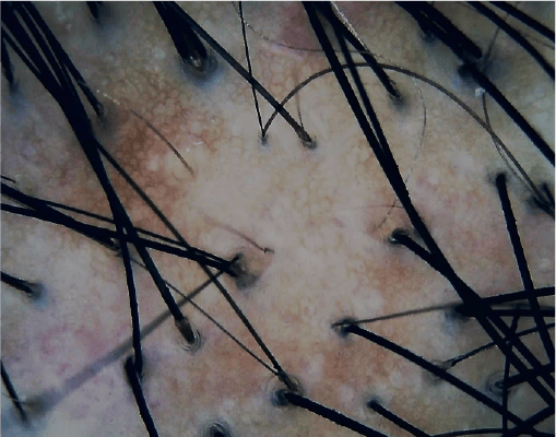 A scalp under cross polarised light