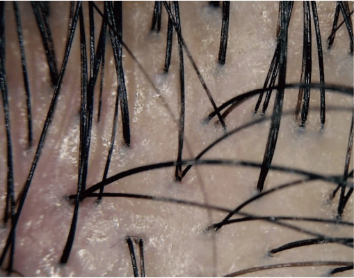 A scalp under normal light