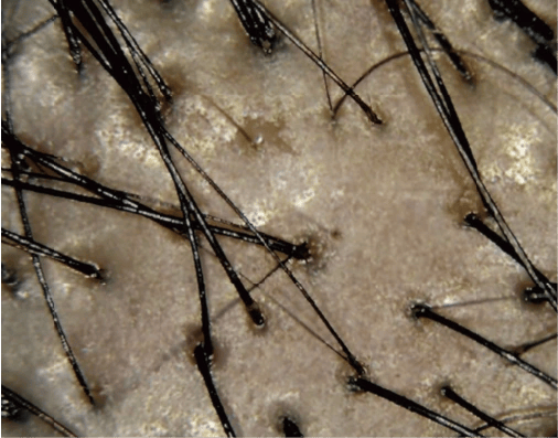A scalp under parallel polarised light